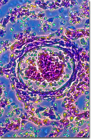 This rather psychedelic looking graphic is actually a blow-up of evidence of the existence of Bronchiopneumonia in the lung.  Man, Bronchiopneumonia never looked better!